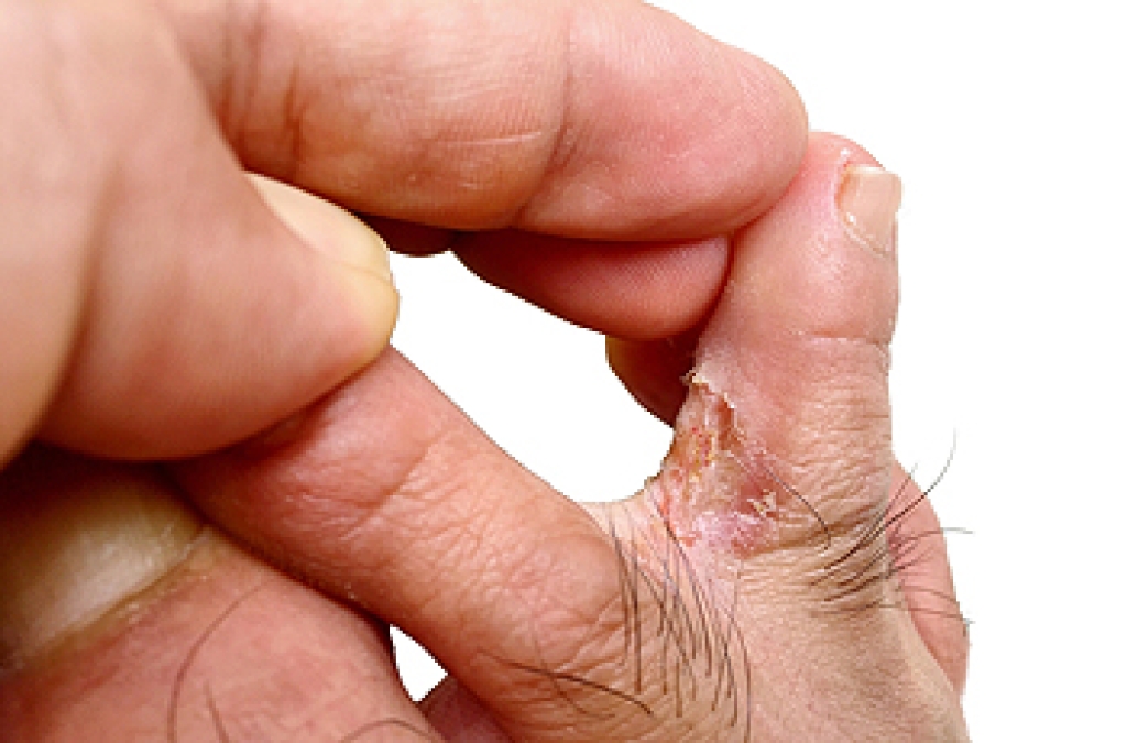 More Than Just an Itchy Foot