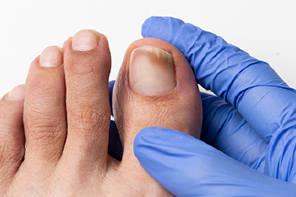 Signs of Toenail Fungus
