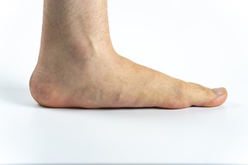 Recognizing the Symptoms of Flat Feet and Finding Relief