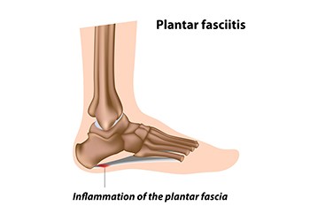 Understanding Plantar Fasciitis and How to Find Relief