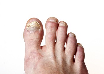 What Causes Toenails to Become Thick