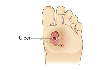 Why Diabetic Foot Ulcers Happen and Who They Affect