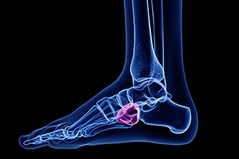 Foot Pain Caused by Cuboid Syndrome