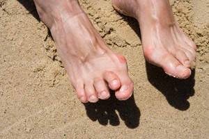 Possible Reasons Why Hammertoe Develops