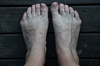 Facts About Tailor's Bunion